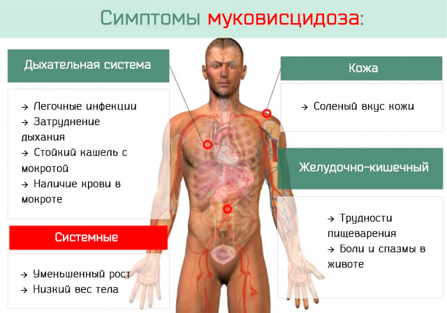 Муковисцидоз (кистозный фиброз) - что это, симптомы, лечение и анализы | ЛабСтори